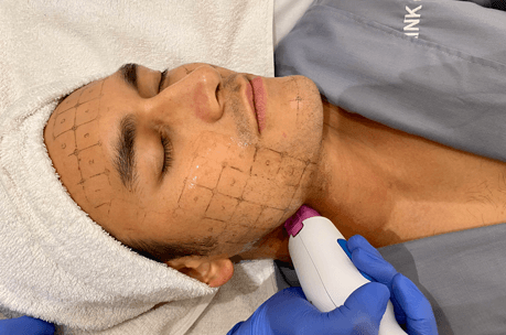 arifin putra getting grids on his face before a treatment at blink beauty clinic.