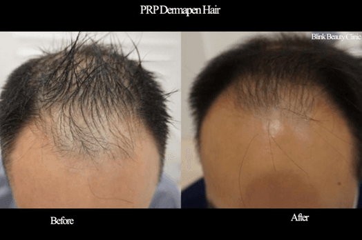 Before and after results of a PRP Dermapen hair treatment at Blink Beauty clinic