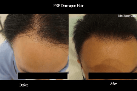 Before and after results of a PRP Dermapen hair treatment at Blink Beauty clinic