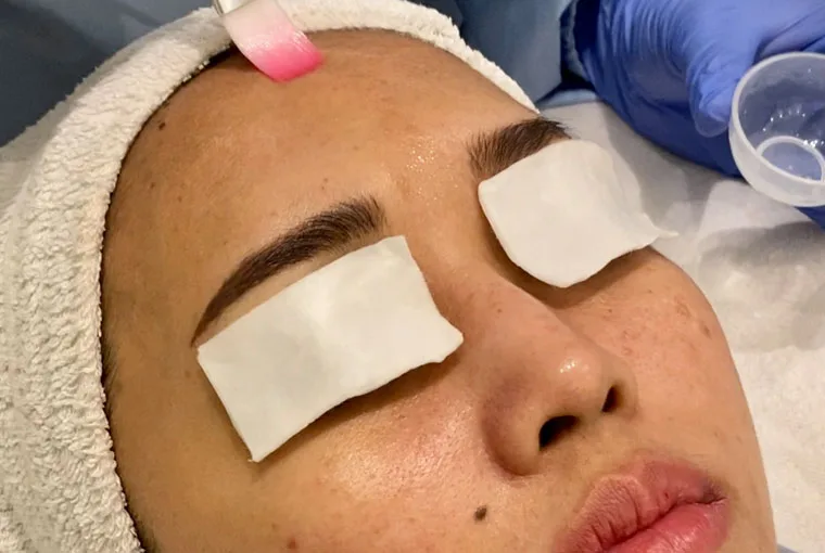 Picture of a woman's face getting instant glow treatment to reduce acne at Blink Beauty clinic.