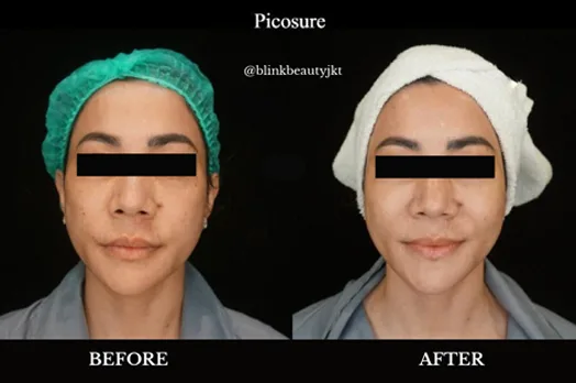 Before and after photo showing the results Picosure Pro Laser treatment at Blink Beauty Clinic.