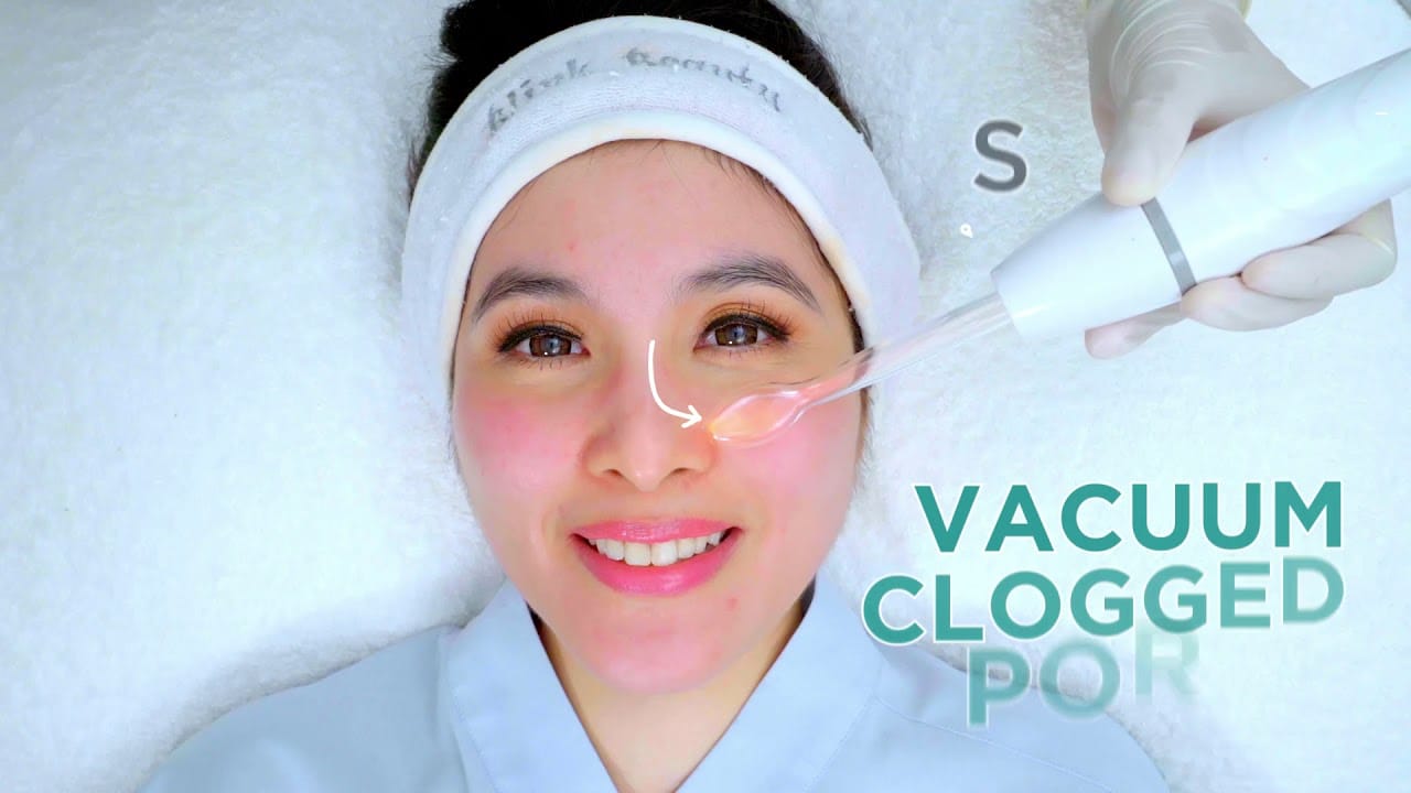 Closeup of Sandra Dewi getting acne reduction silkpeel treatment at Blink beauty Clinic while smiling at the camera