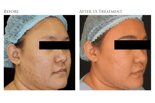 Before and after photo showing the results scar remove treatment at Blink Beauty Clinic.