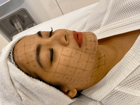 Titi Kamal lying down on a treatment bed at Blink Beauty Clinic with a grid on her face before a treatment.