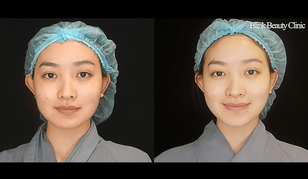 Before and after photo showing the results of a facial program at the Blink Beauty Clinic.