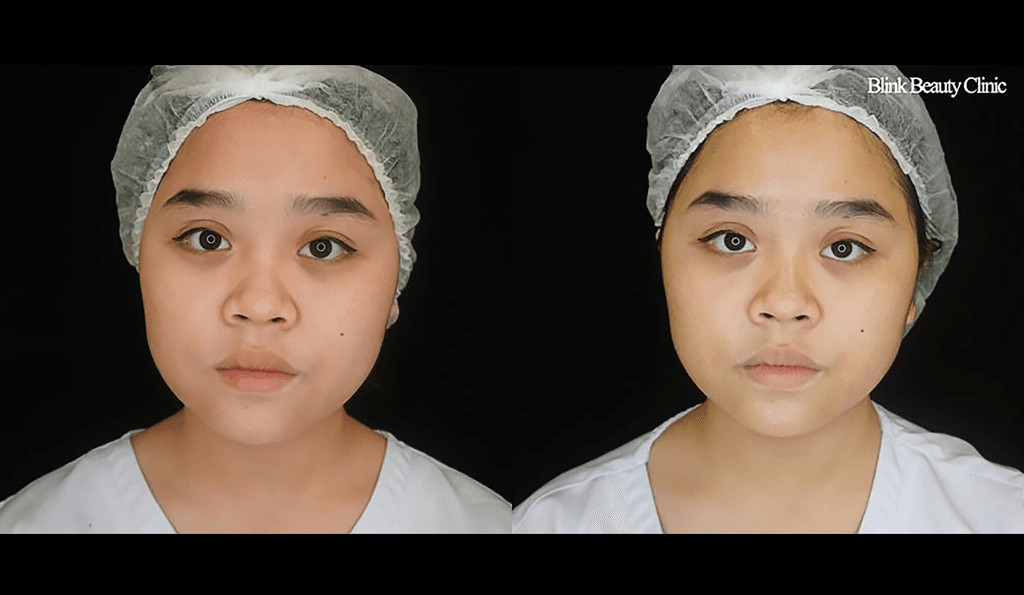 Before and after photo showing the Vshape results of a Blink Beauty Clinic treatment.